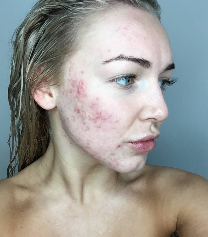 My Journey: My Skin Story