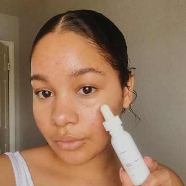 Properly Treating Acne