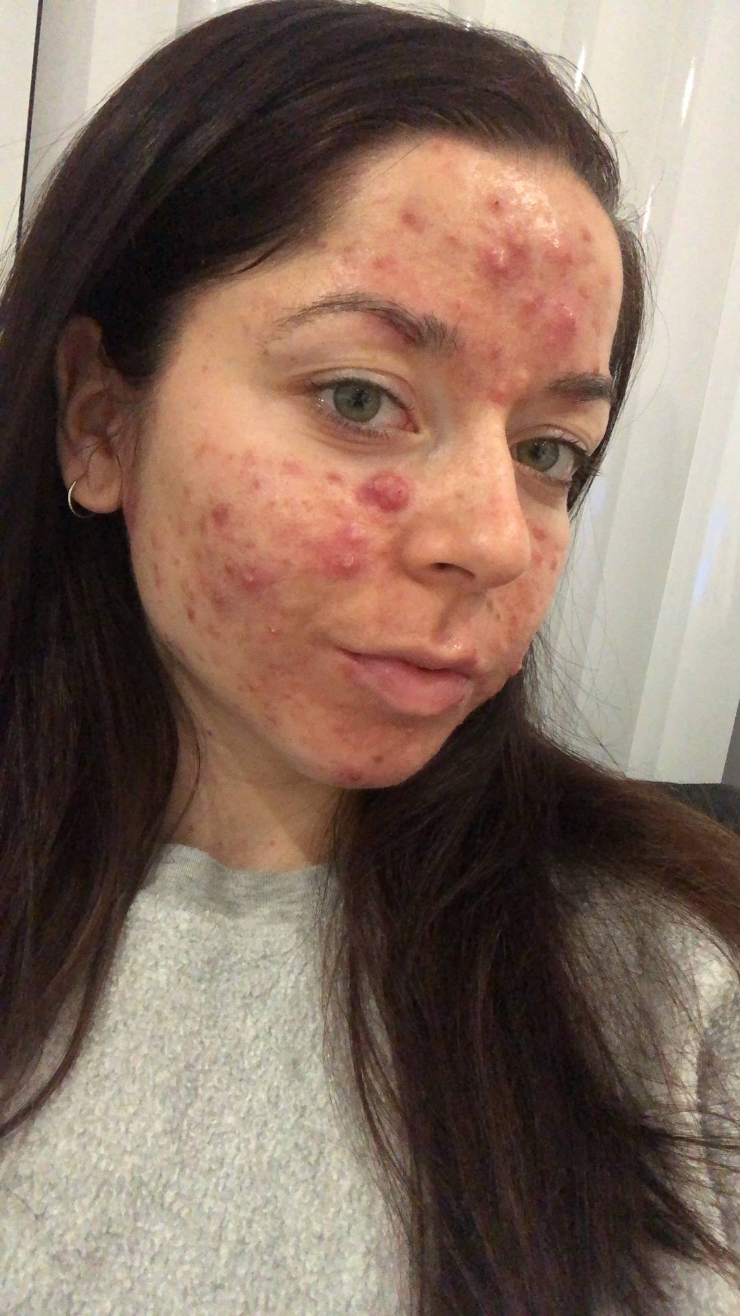 Dealing With Acne: Emily Pt 2