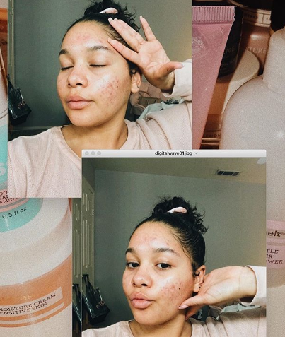 Dealing With Acne Scars
