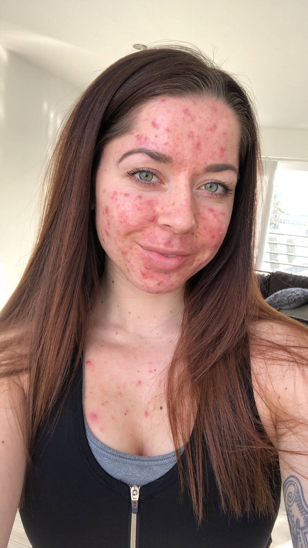 Dealing With Acne: Emily