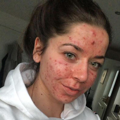 Acne is Normal: Emily