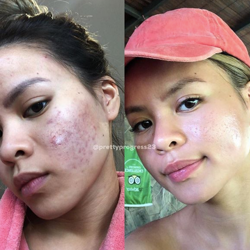 Acne is Normal: Elizabeth