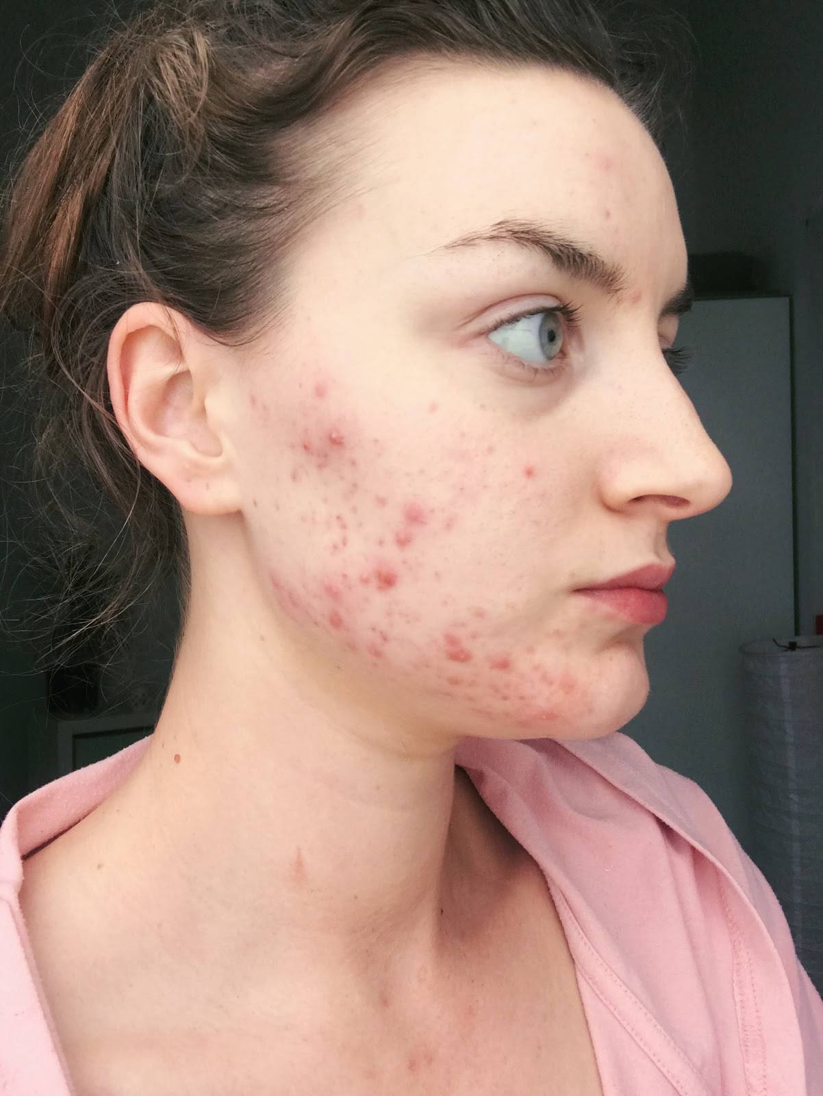Acne is Normal: Skin with Lea