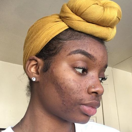 The One Piece of Advice That Will Improve Your Confidence With Acne